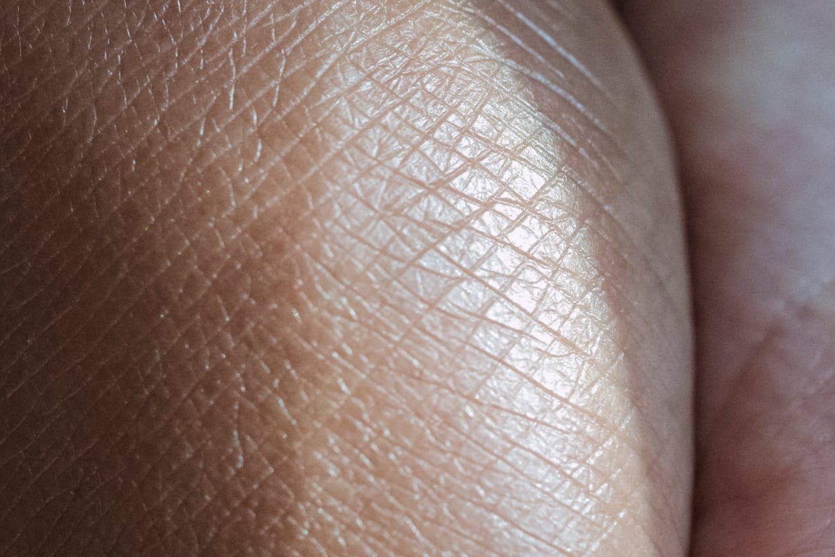 Nesselsucht im Sommer: Antihistaminika und Salben [2026]